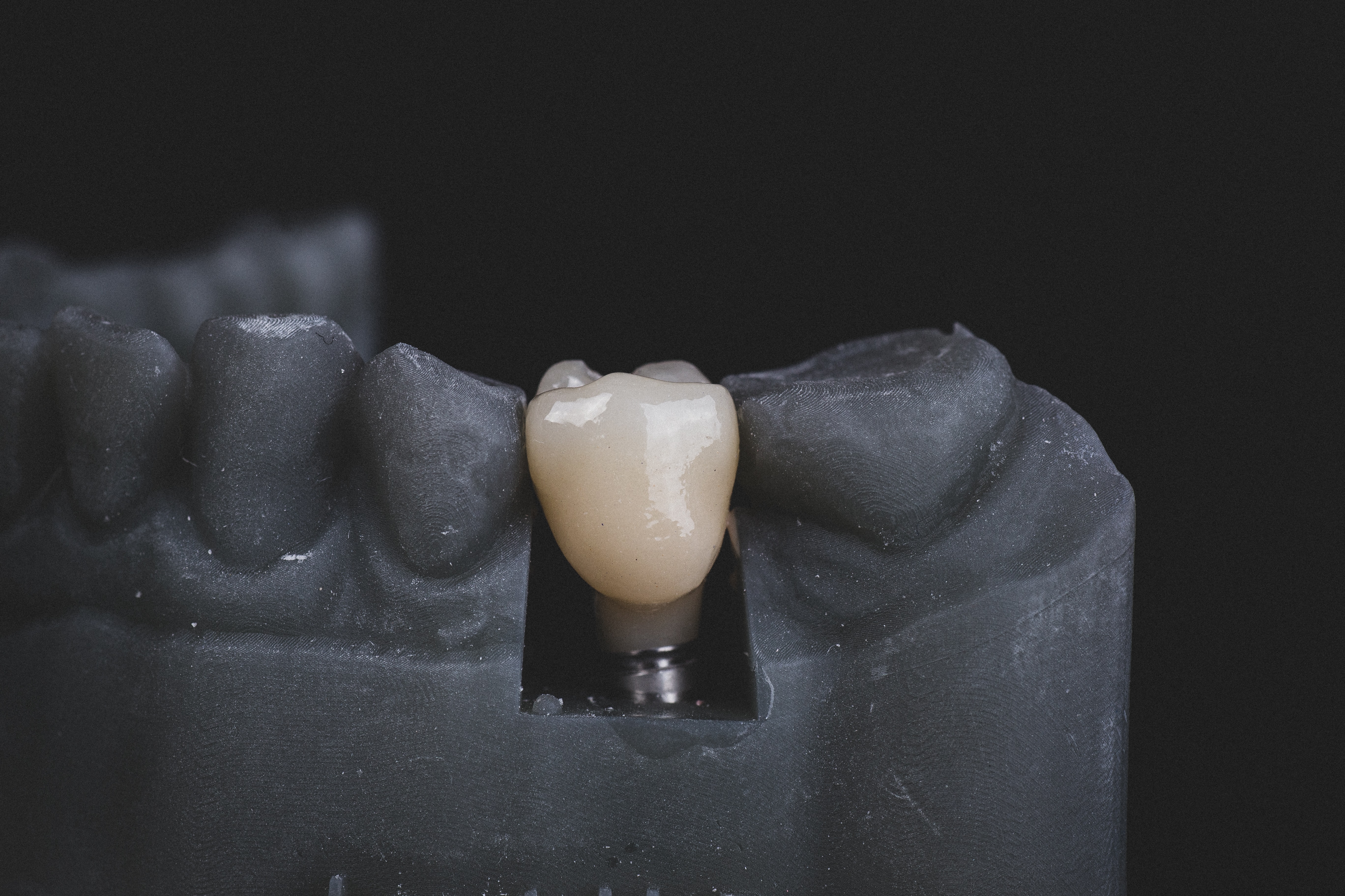 Dental implant; Credit: Bogdan Condr on Unsplash